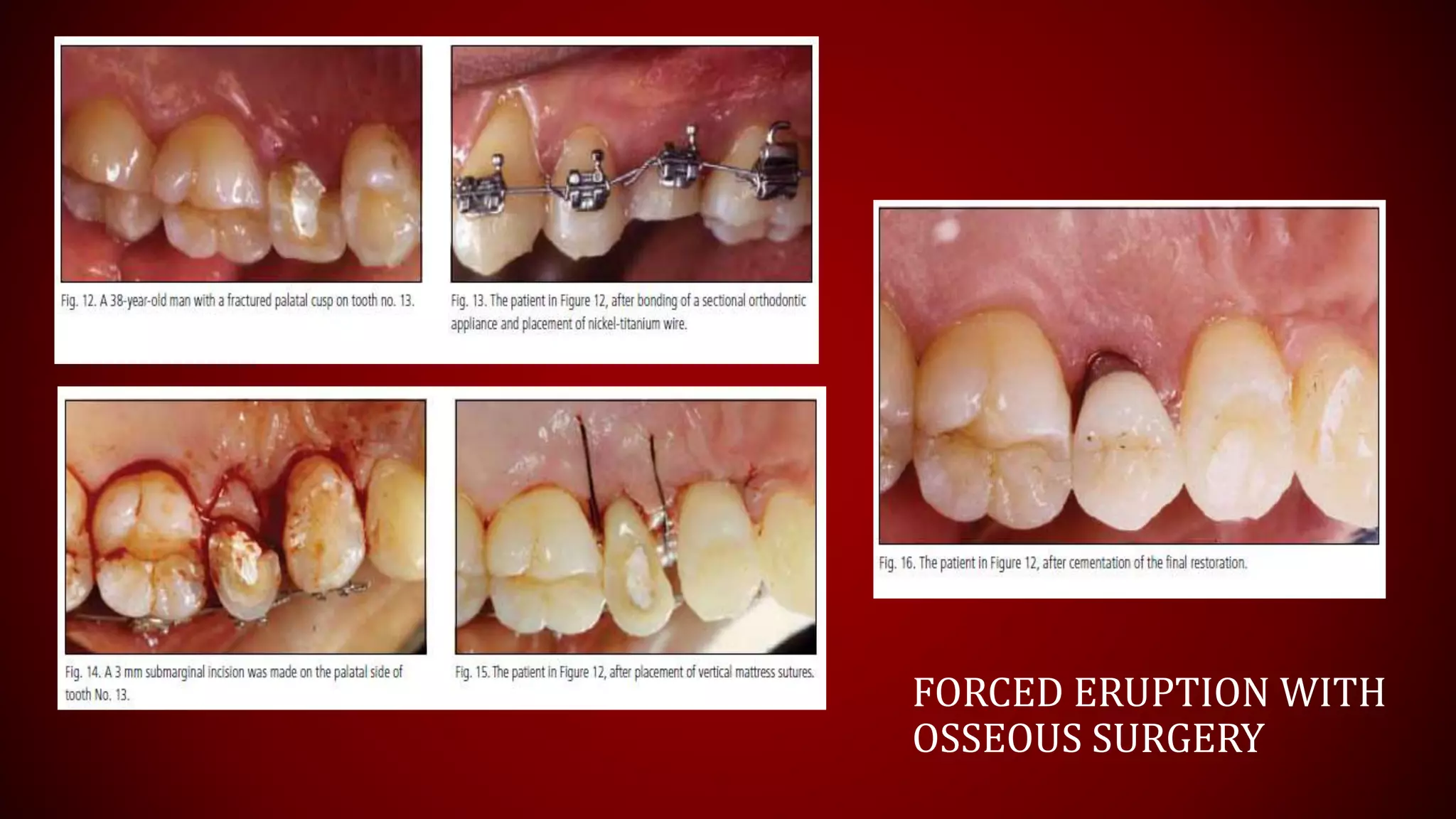 FORCED ERUPTION WITH
OSSEOUS SURGERY
 