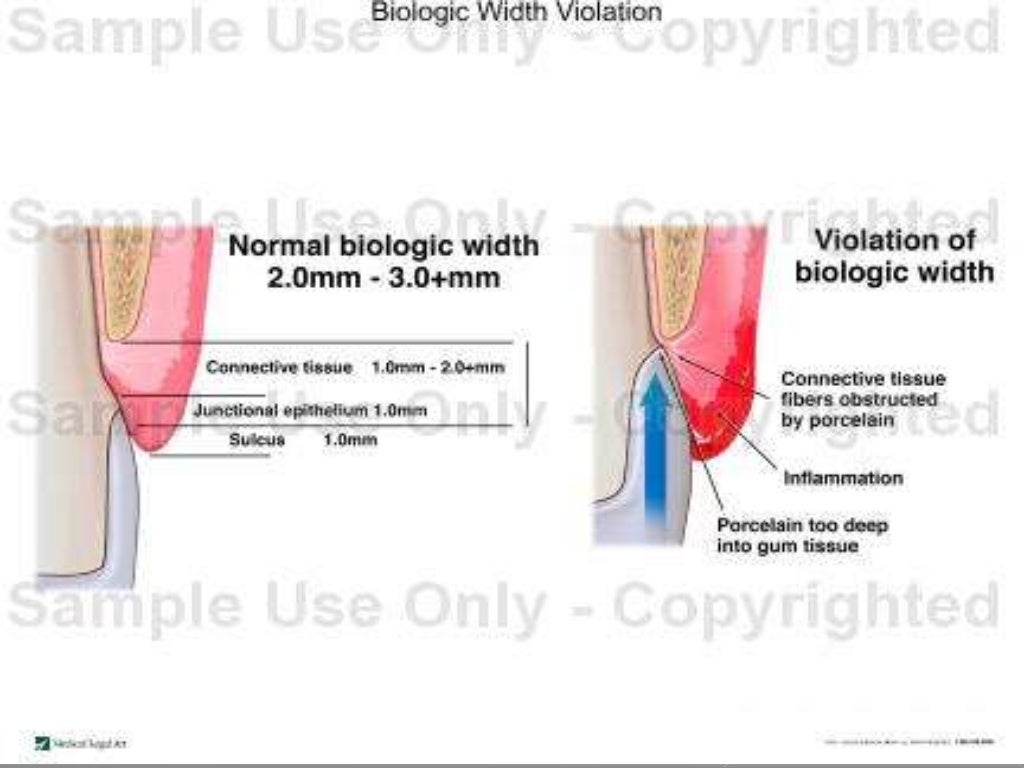Biologic width Importance in Periodontal and Restorative Dentistry