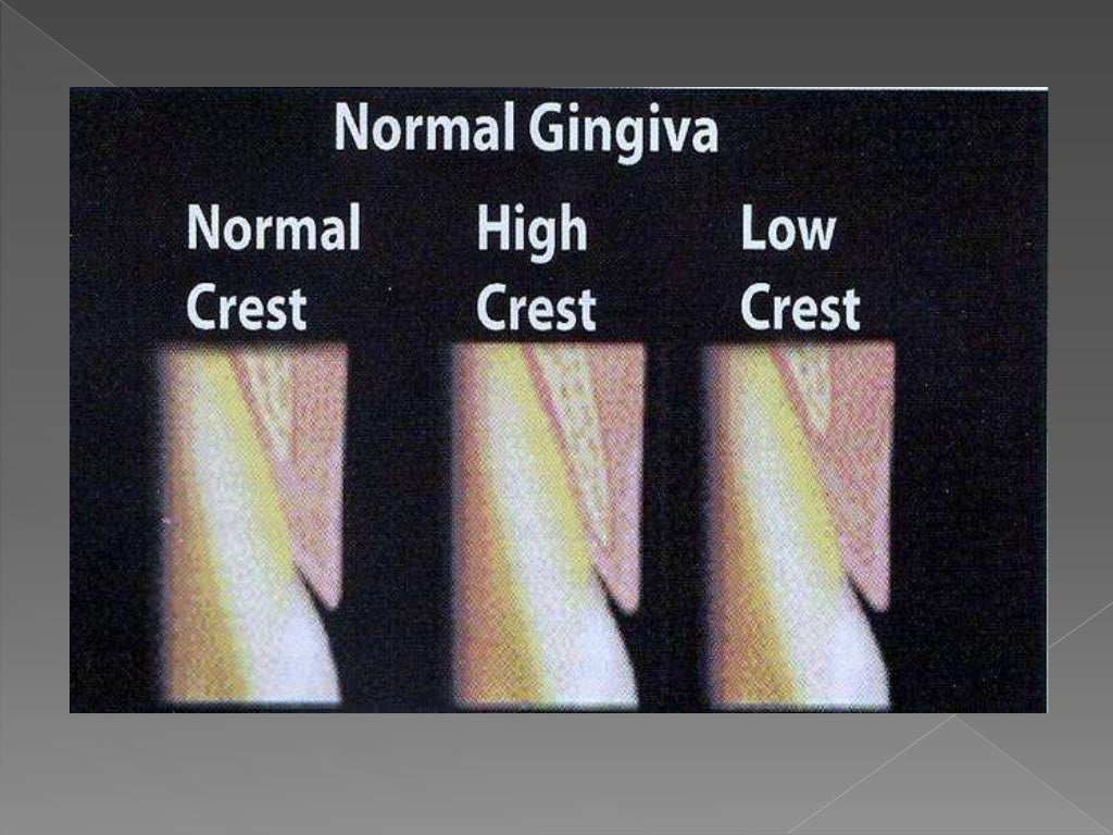 Biologic width Importance in Periodontal and Restorative Dentistry