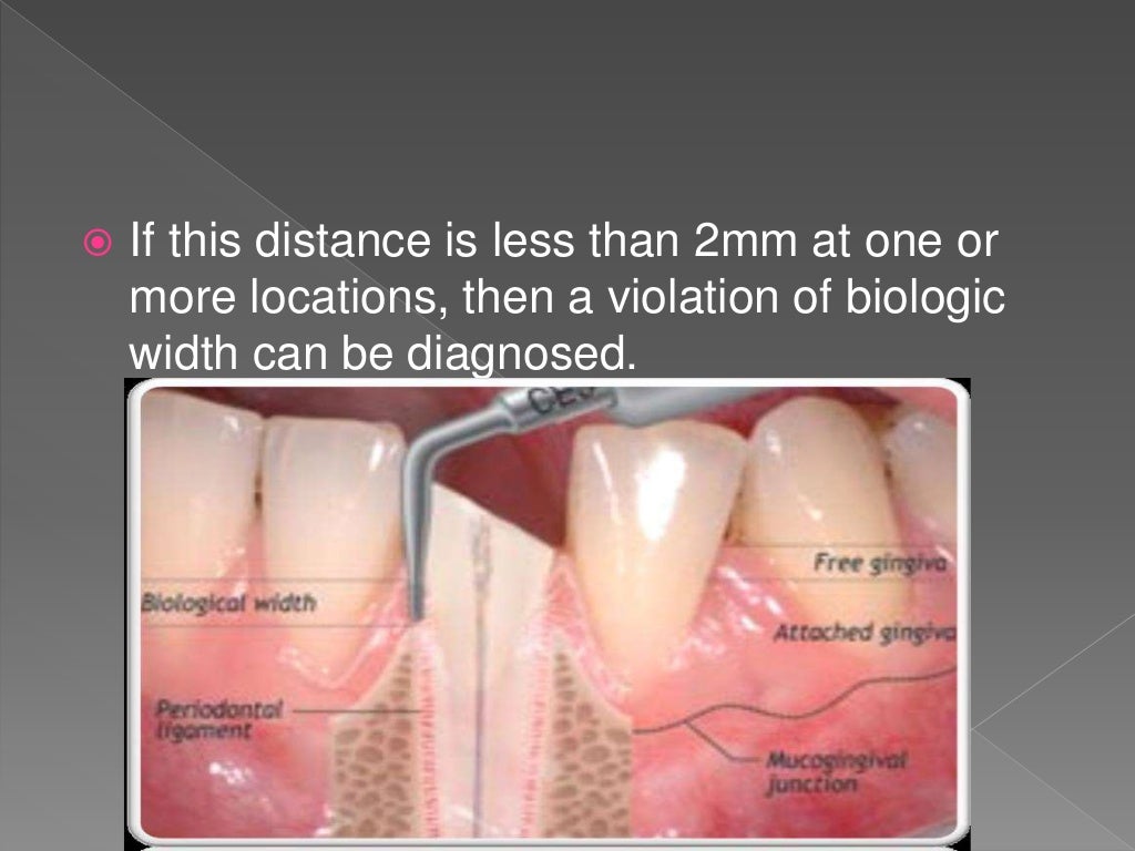 Biologic width Importance in Periodontal and Restorative Dentistry