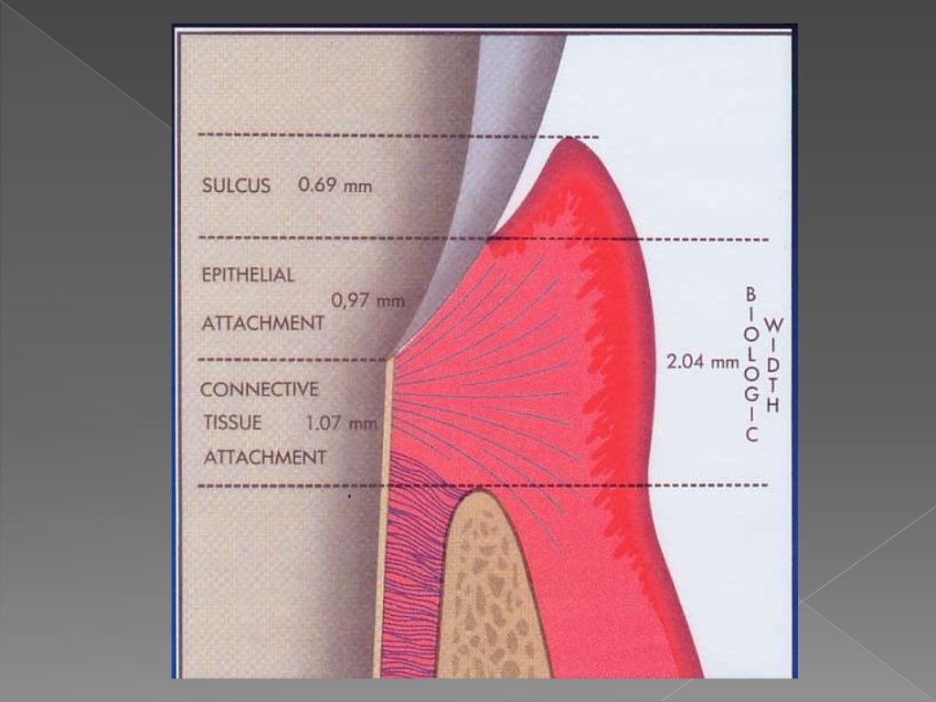 Biologic width Importance in Periodontal and Restorative Dentistry