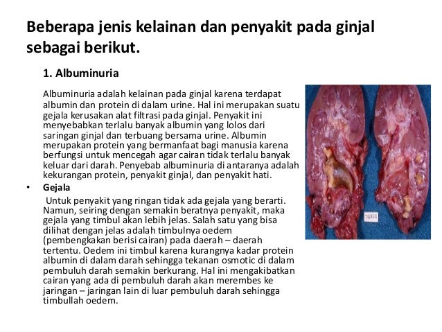 Kelainan Dan penyakit Pada Ginjal