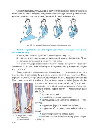 134
Ознаками забоїв і розтягнення зв’язок є: різкий біль під час натискання на
місце травми; синці, набряки; порушення або втрата рухливості у травмовано-
му місці; можливі судоми; втрата дієздатності травмованого м’яза.
Загальні принципи надання першої допомоги у випадку забоїв і роз-
тягнення зв’язок:
а) влаштуйте якомога зручніше травмовану частину тіла;
б) прикладіть до ушкодженого місця холодний компрес і залиште на 30 хв;
в) накладіть на ушкоджене місце тугу пов’язку;
г) за сильного удару після зазначених вище заходів потерпілого необхідно
доправити до лікарні, щоб не пропустити серйознішого ушкодження, напри-
клад, перелому.
Часто вивихи супроводжуються переломами  — ушкодженням кістки з
порушенням її цілісності. Розрізняють закриті та відкриті переломи. Якщо
перелом закритий, то травмується лише кістка (іл. 94). Відчувається сильний
біль, ушкоджене місце набрякає. Інколи спостерігають зміну форми кінців-
ки внаслідок зміщення зламаної кістки. За відкритих
переломів гострі кінці кісток розривають м’язи, кро-
воносні судини, нерви, шкіру  — утворюється рана
(іл. 94 б).
Ознаками переломів є:
● різкий біль у ділянці перелому;
● набряк, синці, а за відкритих переломів — кро-
вотечі;
● порушення форми й довжини кінцівки;
● порушення або втрата рухливості в місці пере-
лому;
● відчуття хрускоту за спроби руху;
● можливі ознаки больового шоку (стан непри-
томності).
Іл. 93. Послідовність накладання косинкової пов’язки
Іл. 94. Переломи кісток:
а — закритий;
б — відкритий
 