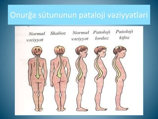 Onurğa sütununun pataloji vəziyyətləri
 