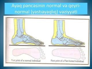 Ayaq pəncəsinin normal və qeyri-
normal (yastıayaqlıq) vəziyyəti
 
