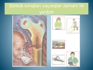 Sümük sınıqları vəçıxıqlar zamanı ilk
yardım
 