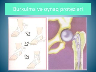 Burxulma və oynaq protezləri
 