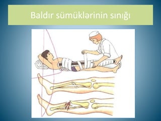 Baldır sümüklərinin sınığı
 