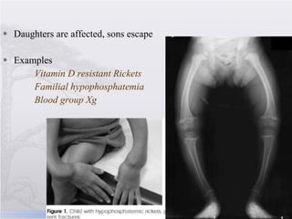 <ul><li>Daughters are affected, sons escape </li></ul><ul><li>Examples </li></ul><ul><li>Vitamin D resistant Rickets </li>...