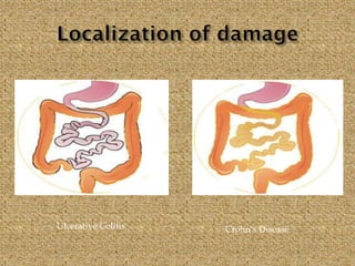 Ulcerative Colitis Crohn’s Disease
 