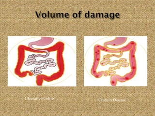 Ulcerative Colitis Crohn’s Disease
 