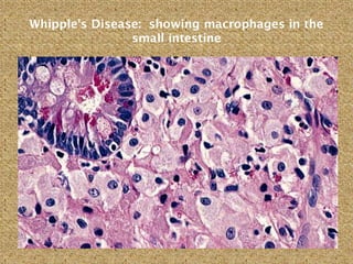 Whipple's Disease: showing macrophages in the
small intestine
 