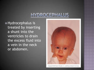 HydrocephalusHydrocephalus is treated by inserting a shunt into the ventricles to drain the excess fluid into a vein in the neck or abdomen.