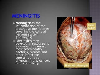 MeningitisMeningitis is the inflammation of the protective membranes covering the central nervous system (meninges)
