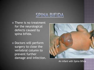 3 TypesSpina bifida occulta – not severe results in a small tuft of hair on the back and has no neurological ramifications.Spina bifida meningocele – more severe, a sac-like cyst protrudes from the child’s spine.  The cyst contains CSF and Meninges.Spina bifida myelomeningocele – similar to above only the cyst contains neural structures.  The more neurological structures the cyst contains the more neurological impairment.