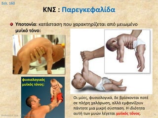 ΚΝΣ : Παρεγκεφαλίδα
Υποτονία: κατάσταση που χαρακτηρίζεται από μειωμένο
μυϊκό τόνο:
Βιολογία Α' Λυκ.- Θ.Ταντανάσης 75
Σελ. 160
φυσιολογικός
μυϊκός τόνος:
Οι μύες, φυσιολογικά, δε βρίσκονται ποτέ
σε πλήρη χαλάρωση, αλλά εμφανίζουν
πάντοτε μια μικρή σύσπαση. Η ιδιότητα
αυτή των μυών λέγεται μυϊκός τόνος.
 