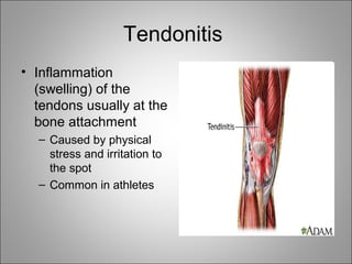 Tendonitis
• Inflammation
(swelling) of the
tendons usually at the
bone attachment
– Caused by physical
stress and irritation to
the spot
– Common in athletes
 