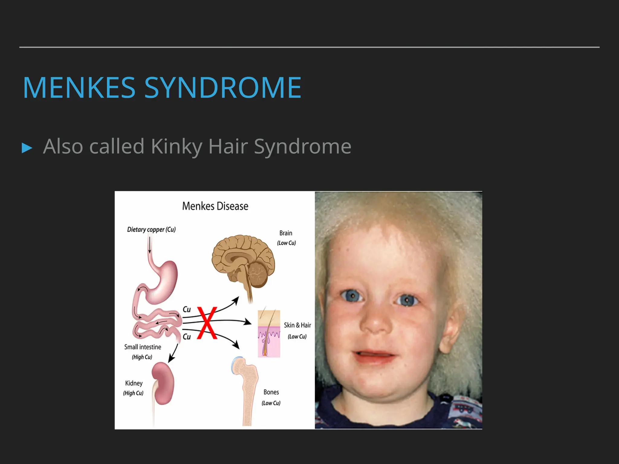 MENKES SYNDROME
▸ Also called Kinky Hair Syndrome
 