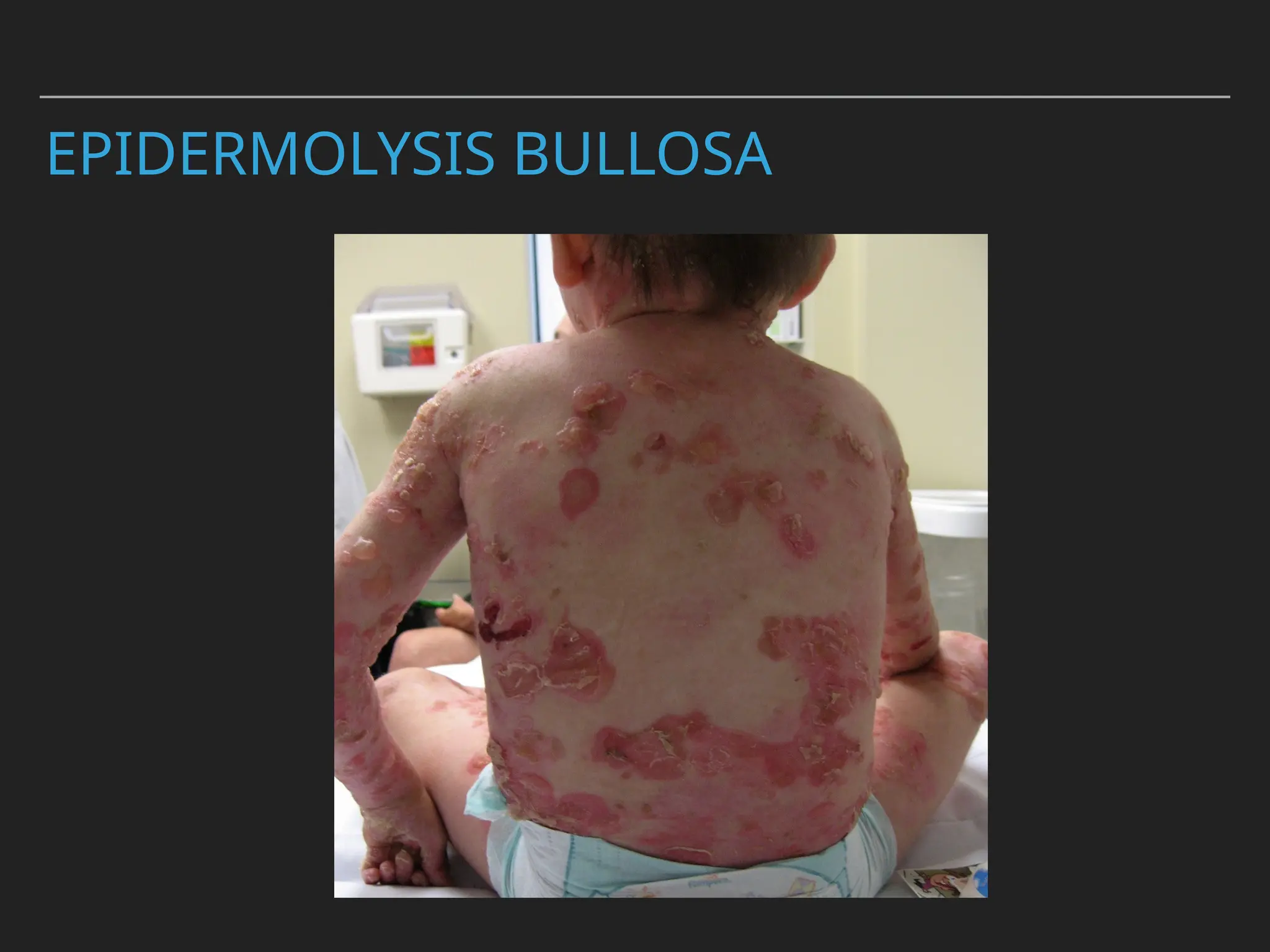 EPIDERMOLYSIS BULLOSA
 
