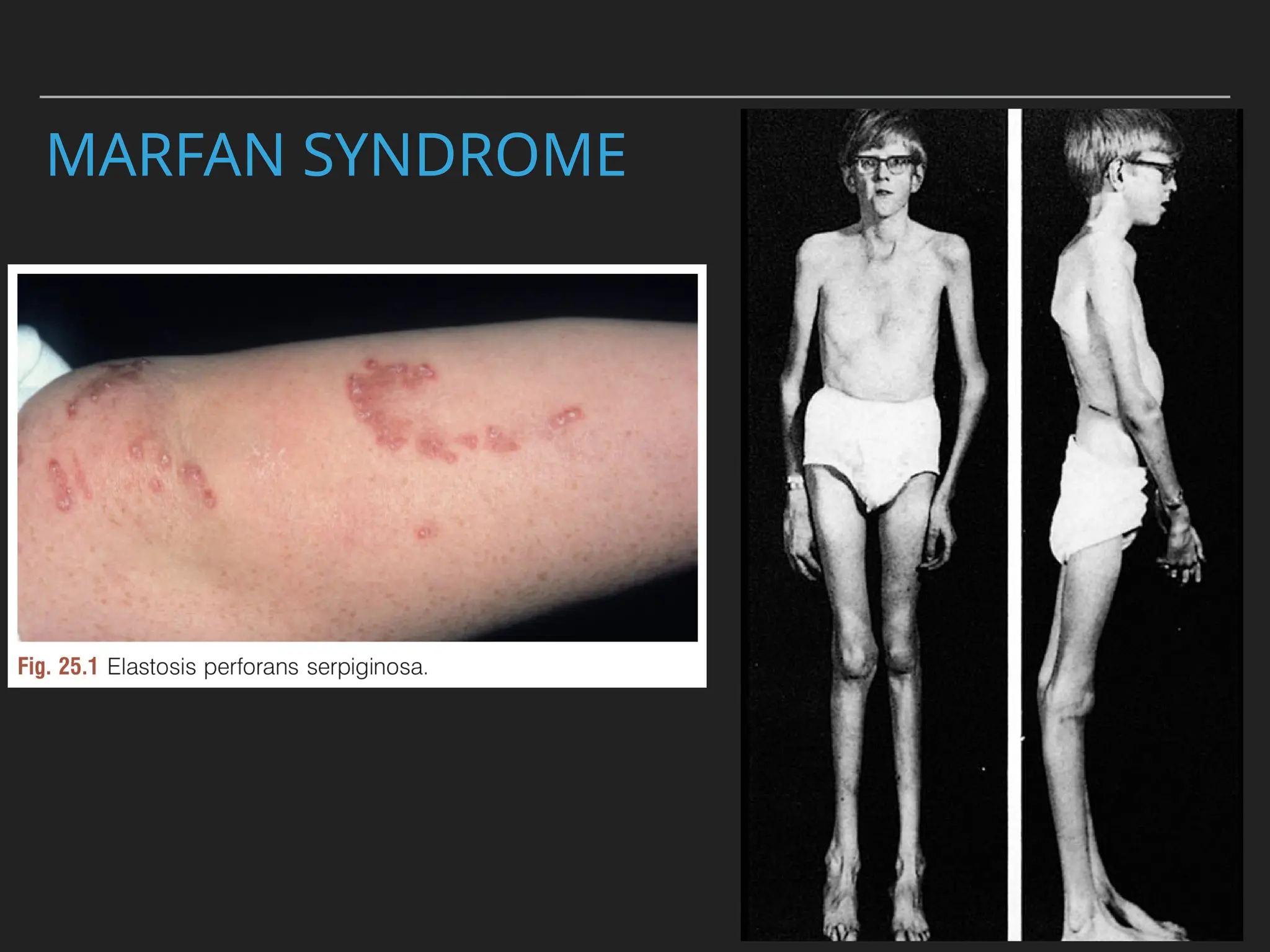 MARFAN SYNDROME
 