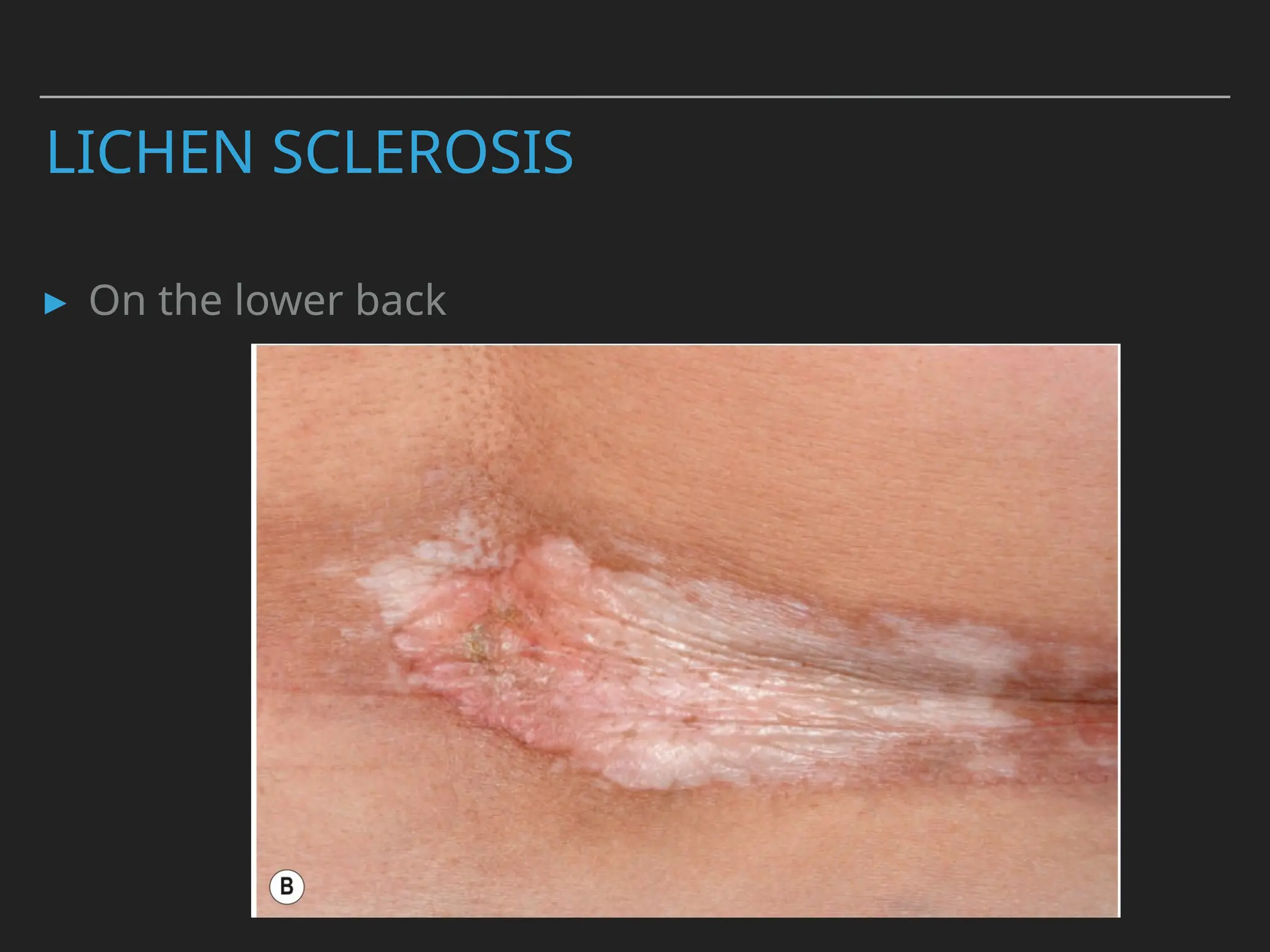LICHEN SCLEROSIS
▸ On the lower back
 