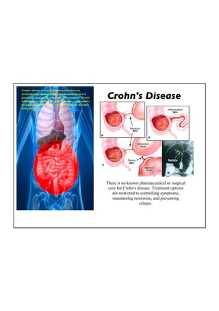 Crohn's disease is caused by interactions between
environmental, immunological and bacterial factors in
genetically susceptible individuals. This results in chronic
inflammation, in which the body's immune system attacks
                                                               Crohn's Disease
the gastrointestinal tract possibly directed at the microbes
living there.




                                                               There is no known pharmaceutical or surgical
                                                                cure for Crohn's disease. Treatment options
                                                                  are restricted to controlling symptoms,
                                                                  maintaining remission, and preventing
                                                                                   relapse.
 