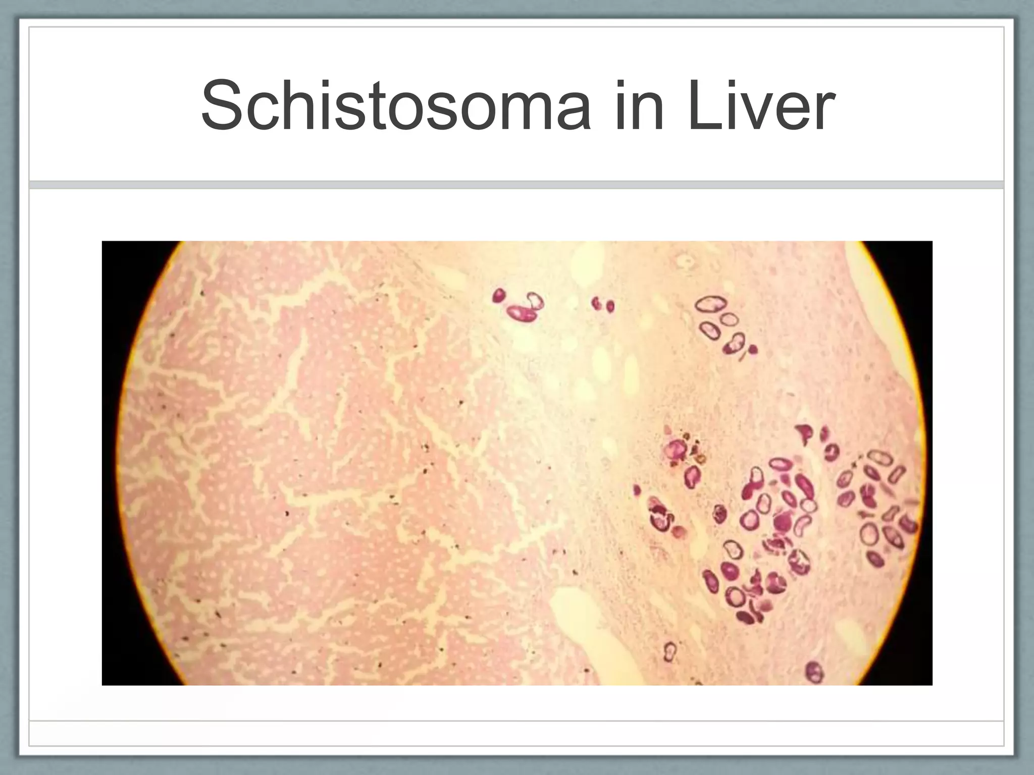 Schistosoma in Liver
 