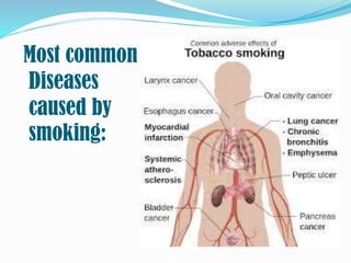 Most common
Diseases
caused by
smoking:
 
