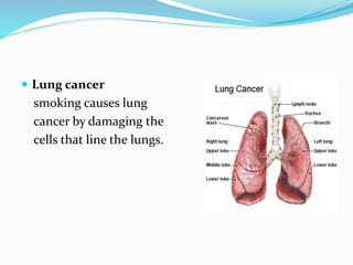 .
 Lung cancer
smoking causes lung
cancer by damaging the
cells that line the lungs.
 