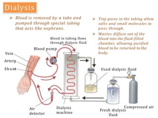  Tiny pores in the tubing allow
salts and small molecules to
pass through.
 Wastes diffuse out of the
blood into the fluid-filled
chamber, allowing purified
blood to be returned to the
body.
Dialysis
Air
detector
Dialysis
machine
Fresh dialysis
fluid
Compressed air
Vein
Artery
Shunt
Blood pump
Used dialysis fluid
 Blood is removed by a tube and
pumped through special tubing
that acts like nephrons.
Blood in tubing flows
through dialysis fluid
 