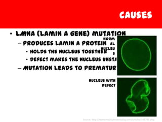 causes
• LMNA (Lamin A gene) mutation
                              Norm
  – Produces Lamin A   protein al
                             Nucleu
    • Holds the nucleustogether s
    • Defect makes the nucleus unstable
  – Mutation leads to premature aging
                           Nucleus with
                                 defect




                       Source: http://www.medicalnewstoday.com/articles/146746.php
 