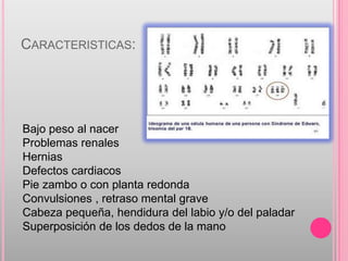 CARACTERISTICAS:




Bajo peso al nacer
Problemas renales
Hernias
Defectos cardiacos
Pie zambo o con planta redonda
Convulsiones , retraso mental grave
Cabeza pequeña, hendidura del labio y/o del paladar
Superposición de los dedos de la mano
 