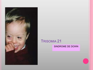 TRISOMIA 21
      SINDROME DE DOWN
 