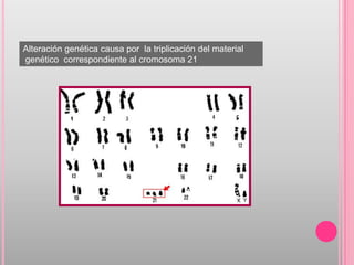 Alteración genética causa por la triplicación del material
genético correspondiente al cromosoma 21
 
