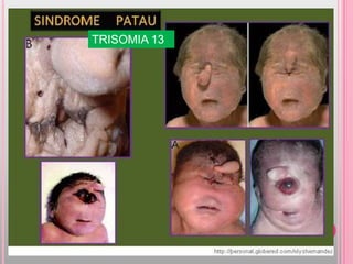 TRISOMIA 13
 