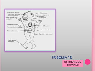 TRISOMIA 18
      SINDROME DE
        EDWARDS
 