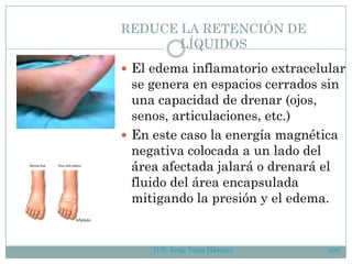 REDUCE LA RETENCIÓN DE
LÍQUIDOS
 El edema inflamatorio extracelular
se genera en espacios cerrados sin
una capacidad de drenar (ojos,
senos, articulaciones, etc.)
 En este caso la energía magnética
negativa colocada a un lado del
área afectada jalará o drenará el
fluido del área encapsulada
mitigando la presión y el edema.
O.N. Jorge Tapia Márquez 100
 
