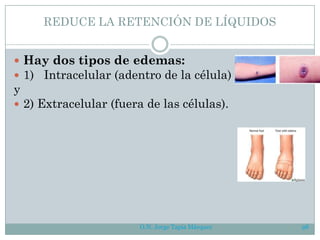 O.N. Jorge Tapia Márquez 98
REDUCE LA RETENCIÓN DE LÍQUIDOS
 Hay dos tipos de edemas:
 1) Intracelular (adentro de la célula)
y
 2) Extracelular (fuera de las células).
 