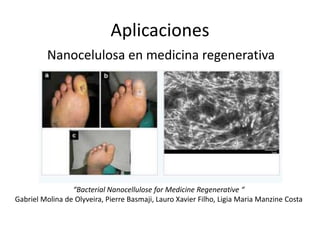 Aplicaciones
Nanocelulosa en medicina regenerativa
“Bacterial Nanocellulose for Medicine Regenerative “
Gabriel Molina de Olyveira, Pierre Basmaji, Lauro Xavier Filho, Ligia Maria Manzine Costa
 