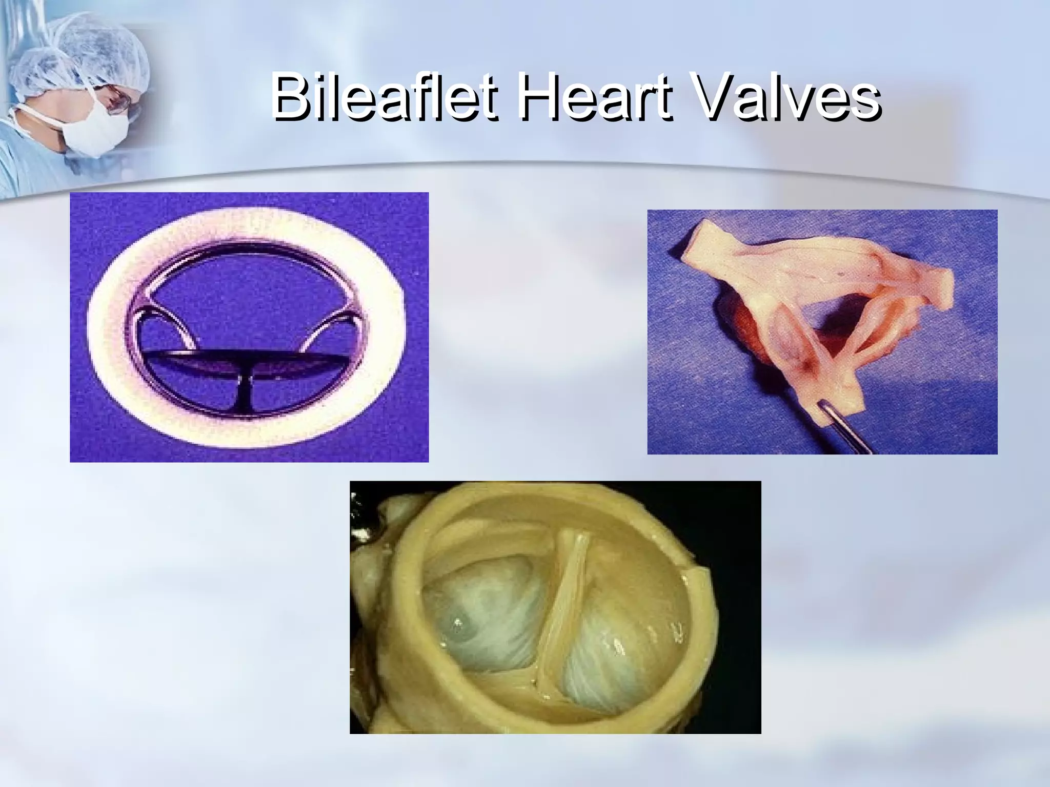 Bileaflet Heart ValvesBileaflet Heart Valves
 