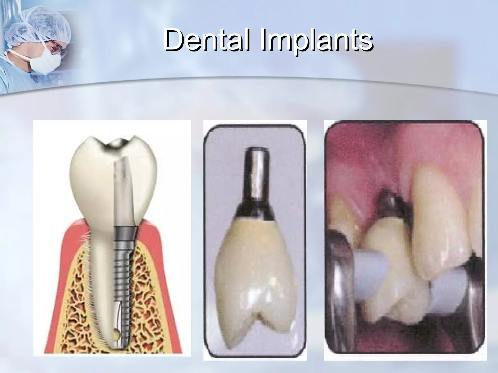 Dental ImplantsDental Implants
 