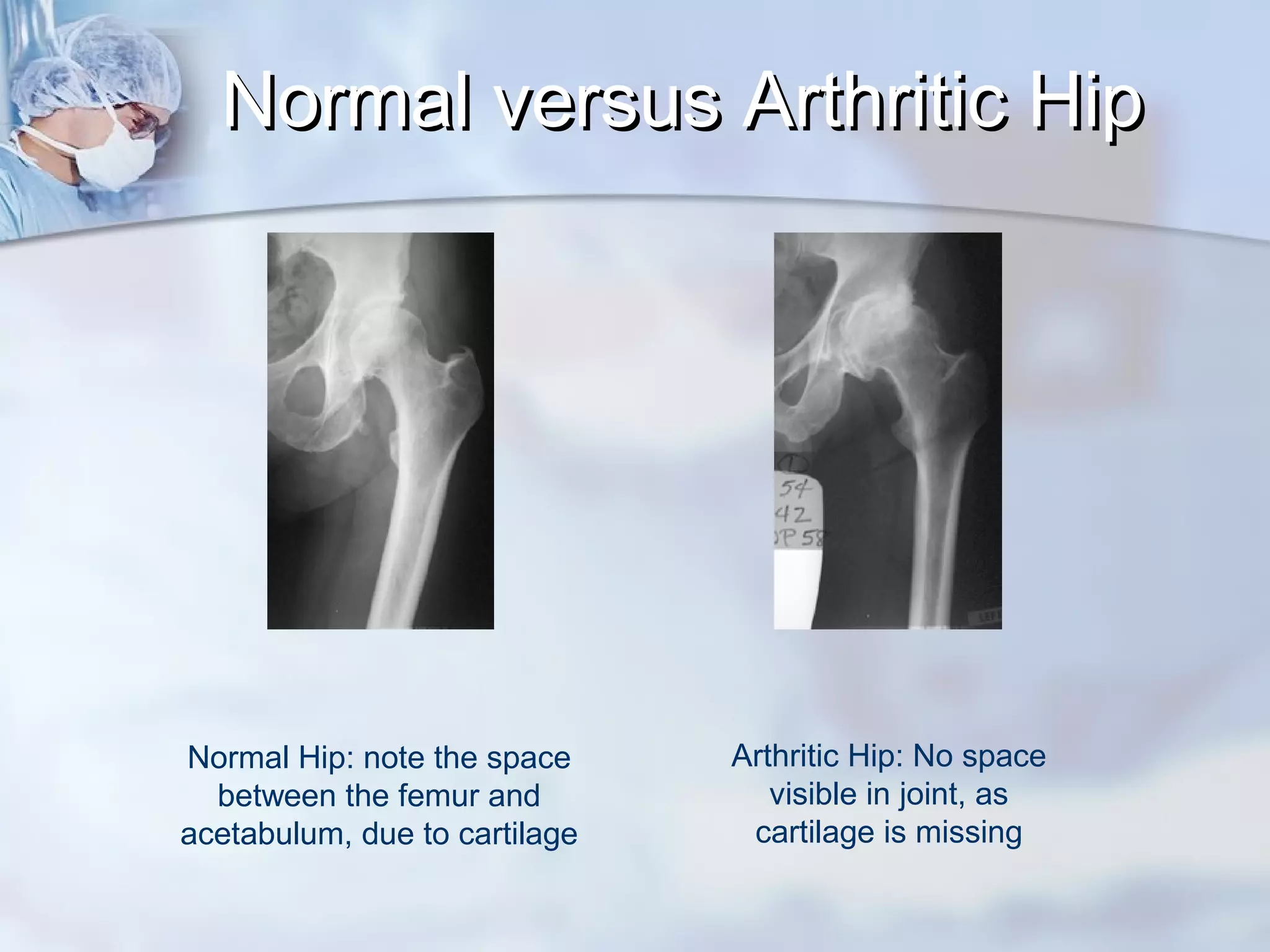 Normal versus Arthritic HipNormal versus Arthritic Hip
Normal Hip: note the space
between the femur and
acetabulum, due to cartilage
Arthritic Hip: No space
visible in joint, as
cartilage is missing
 