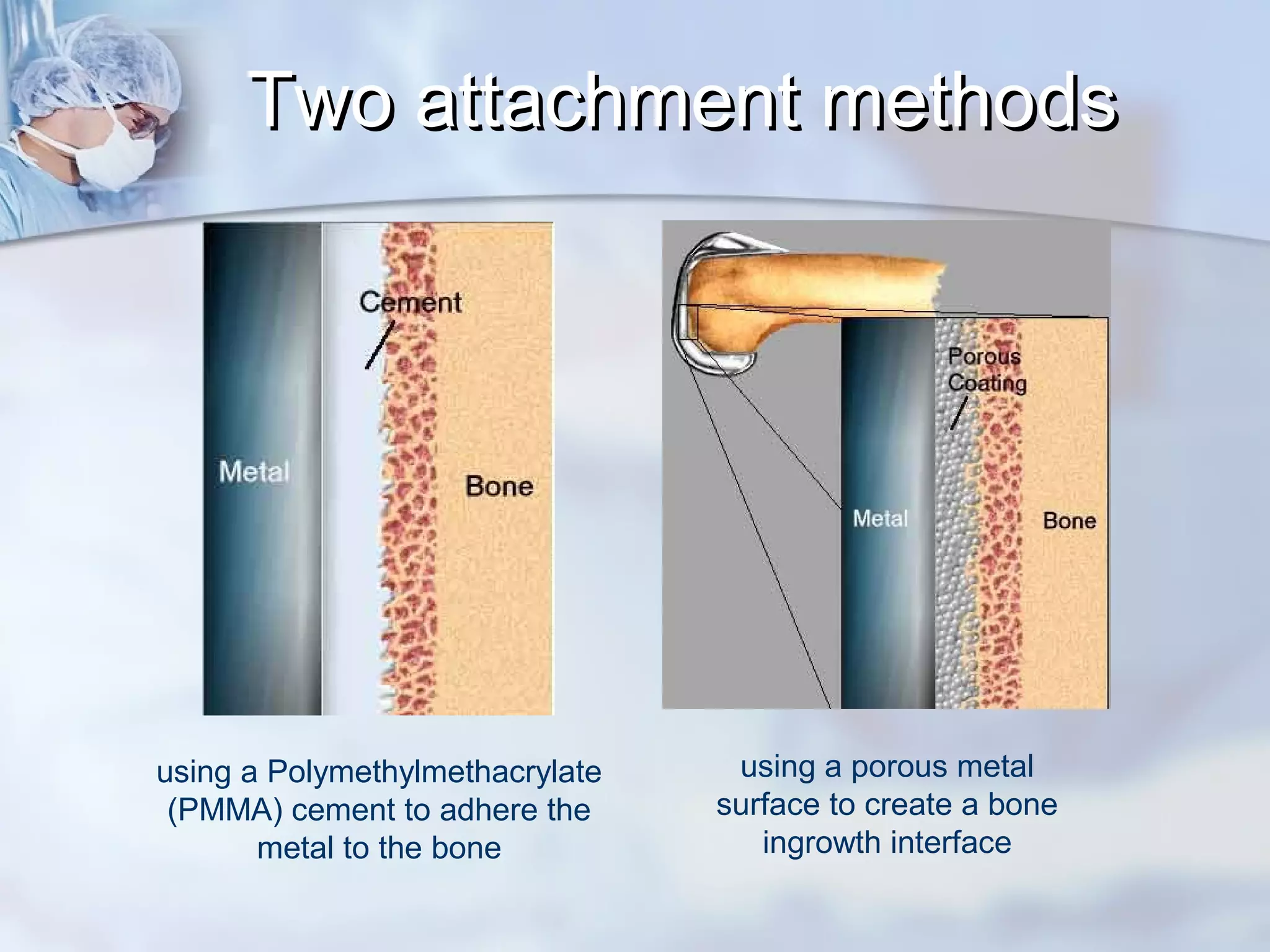 using a Polymethylmethacrylate
(PMMA) cement to adhere the
metal to the bone
using a porous metal
surface to create a bone
ingrowth interface
Two attachment methodsTwo attachment methods
 