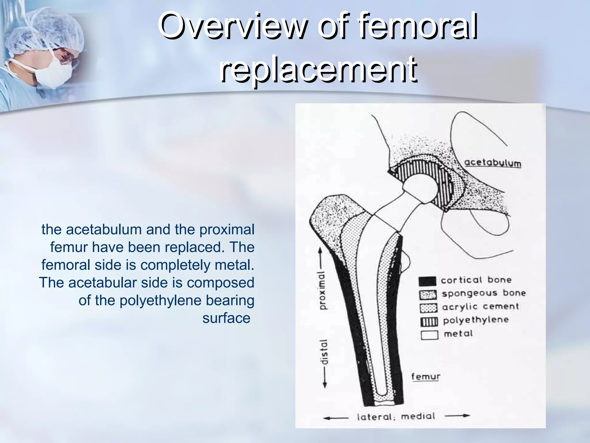 the acetabulum and the proximal
femur have been replaced. The
femoral side is completely metal.
The acetabular side is composed
of the polyethylene bearing
surface
Overview of femoralOverview of femoral
replacementreplacement
 