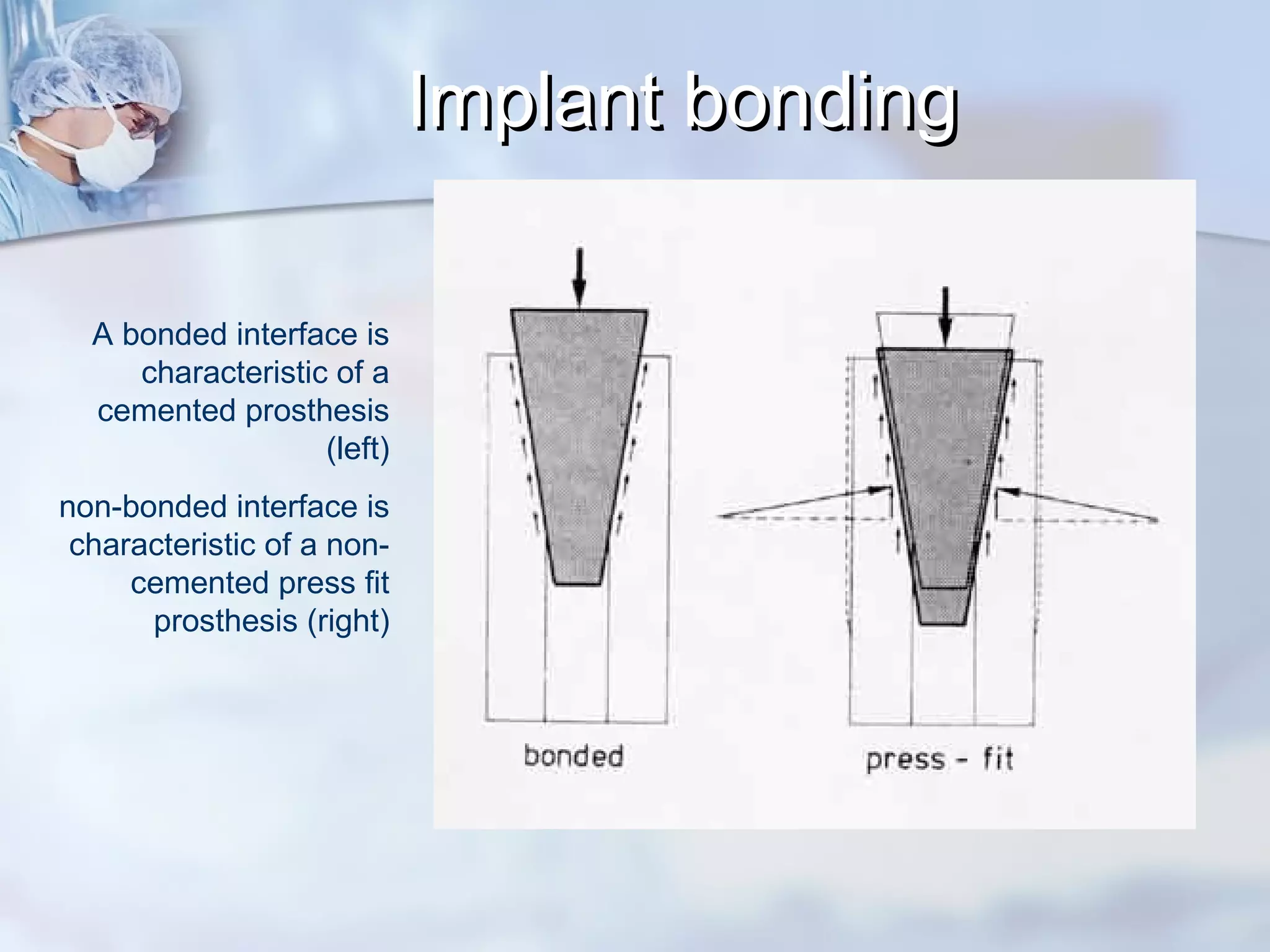 Implant bondingImplant bonding
A bonded interface is
characteristic of a
cemented prosthesis
(left)
non-bonded interface is
characteristic of a non-
cemented press fit
prosthesis (right)
 