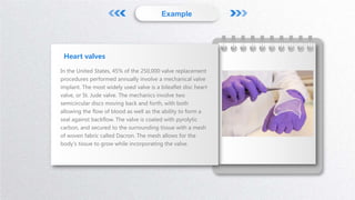 Example
In the United States, 45% of the 250,000 valve replacement
procedures performed annually involve a mechanical valve
implant. The most widely used valve is a bileaflet disc heart
valve, or St. Jude valve. The mechanics involve two
semicircular discs moving back and forth, with both
allowing the flow of blood as well as the ability to form a
seal against backflow. The valve is coated with pyrolytic
carbon, and secured to the surrounding tissue with a mesh
of woven fabric called Dacron. The mesh allows for the
body's tissue to grow while incorporating the valve.
Heart valves
 