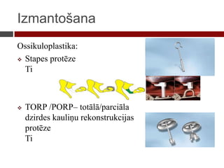 Izmantošana
Ossikuloplastika:
 Stapes protēze
Ti
 TORP /PORP– totālā/parciāla
dzirdes kauliņu rekonstrukcijas
protēze
Ti
 
