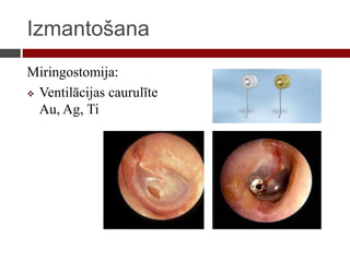 Izmantošana
Miringostomija:
 Ventilācijas caurulīte
Au, Ag, Ti
 