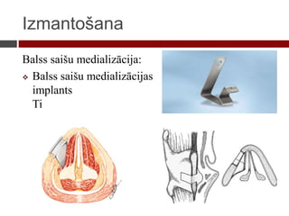 Izmantošana
Balss saišu medializācija:
 Balss saišu medializācijas
implants
Ti
 