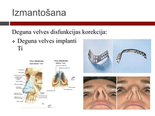 Izmantošana
Deguna velves disfunkcijas korekcija:
 Deguna velves implanti
Ti
 